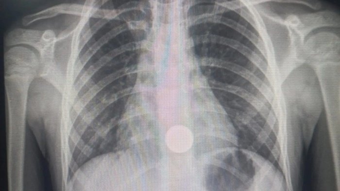 Raio x moeda criança